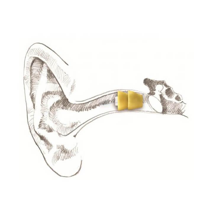 Lyric hearing aid in ear diagram